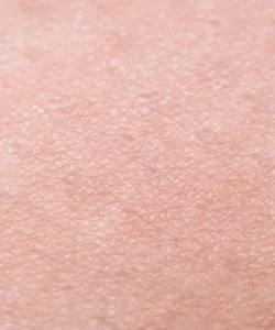 Résultat épilation définitive maillot - Institut de beauté Estética Beauté