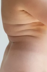 Zone cryolipolyse bourrelet - Institut Estetica Beaute