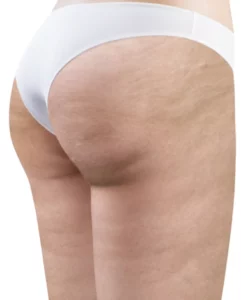 Avant soin minceur LPG fesses - Institut Estetica Beaute